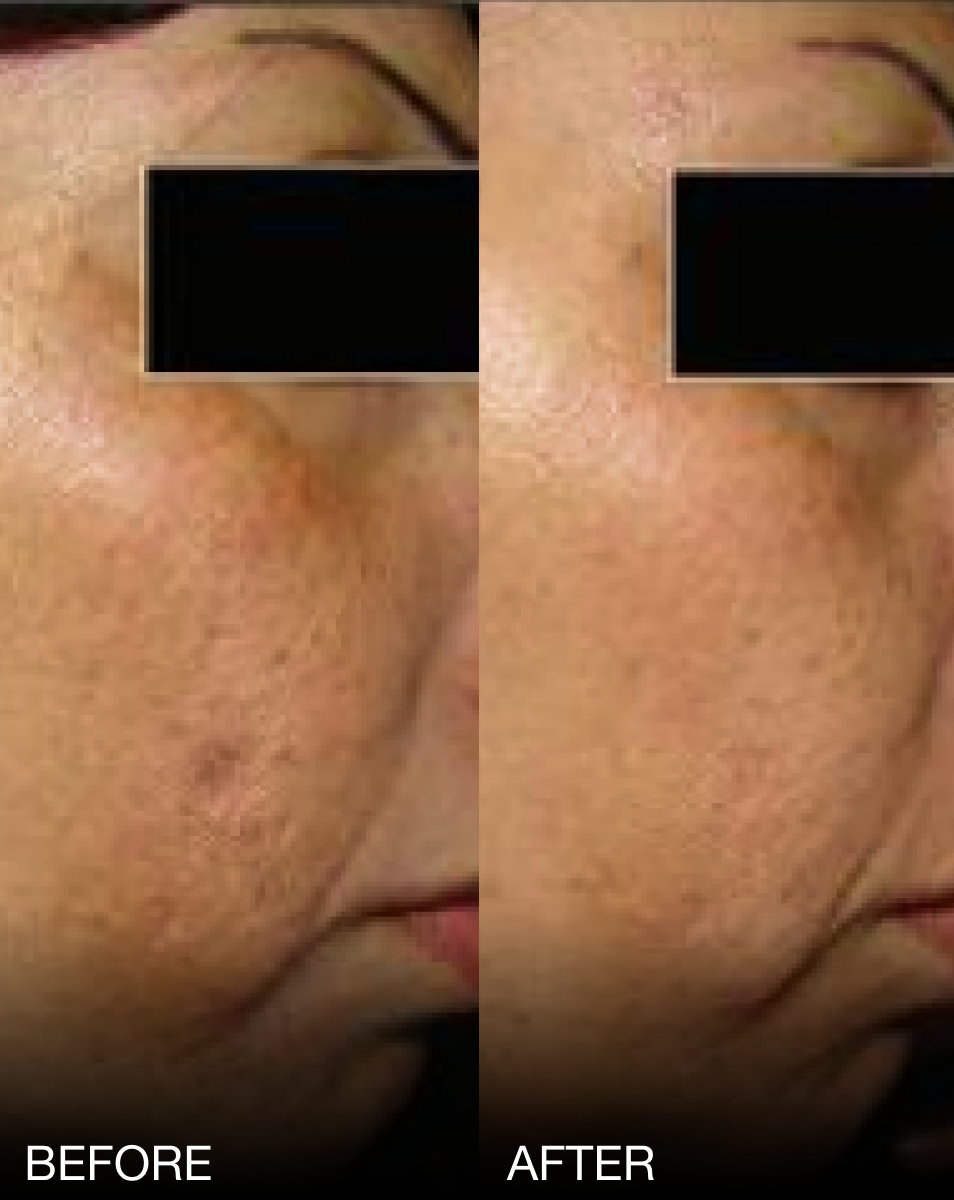 MELACLEAR BRIGHTENING SERUM